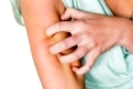 Eine Frau hat nach einem Mückenstich eine juckende Haut und kratzt sich